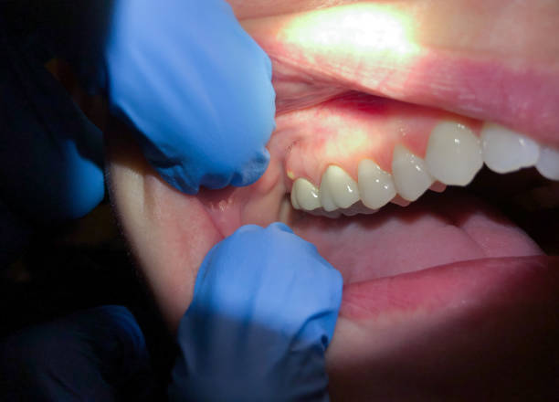 Best Emergency Treatment for Oral Infections in Weston, FL