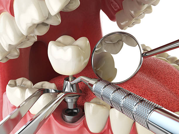Best Emergency Denture Repair in Weston, FL